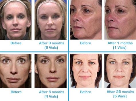 What Is A Liquid Facelift Maloney Center For Facial Plastic Surgery