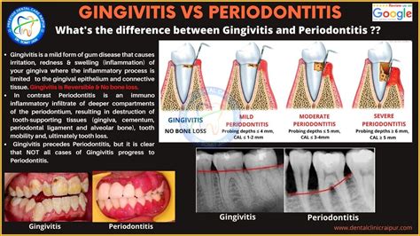 Periodontitis Vs Gingivitis Meaning8 Signs And Symptomsdiagnosis