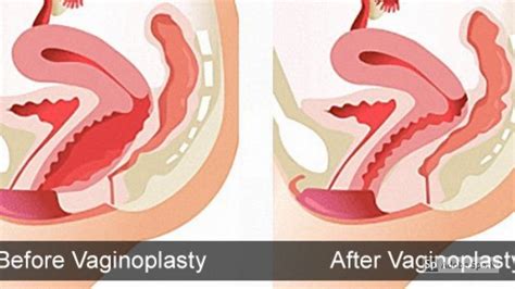 Vaginoplasty Surgery Hymenoplastyrevirgination Vaginal Plastic Surgery Vaginal Rejuvenation