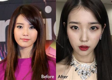Korean Singer Iu Before And After Surgery