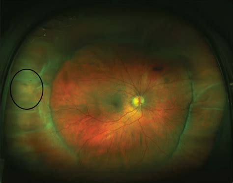 Endoillumination Chandelier Assisted Scleral Buckling For A Complex