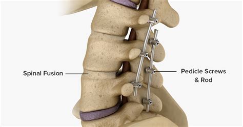 Spinal Fusion Washington Dc Spine Surgeon