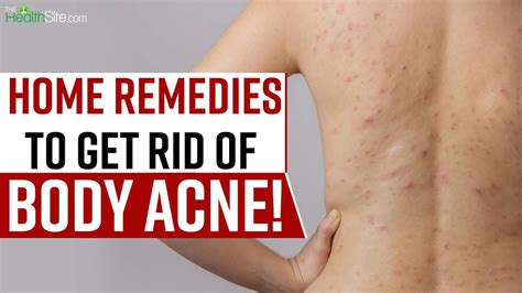 Body Acne Home Remedies These Home Remedies Will Cure You From Body