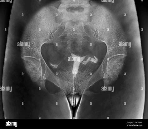 Female Infertility Hystero Salpingogram Contrast Medium X Ray Of The