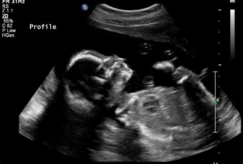 20 Week Ultrasound Why Is It Important