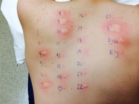 Depending on how allergic you are overall, i.e. Why you should consider food allergy testing