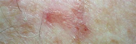 11 Skin Cancer Symptoms You Should Never Ignore Molemap Nz Official Site