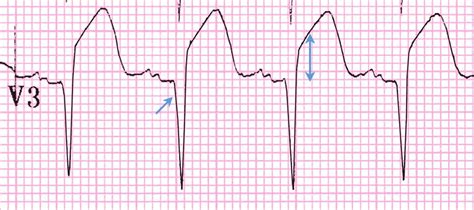 Study Medical Photos Acute Anterior Myocardial Infarction Ecg