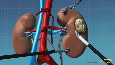 Da Vinci Surgery Patient Education Kidney Cancer Youtube