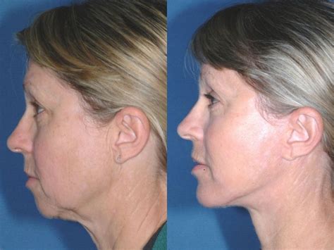 Chin Implants Champaign Chin Augmentation Beforeand After Il