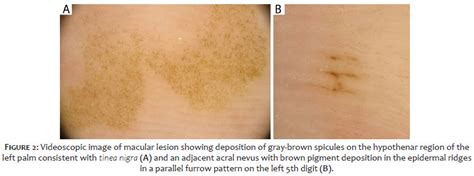 Surgical And Cosmetic Dermatology Role Of Dermoscopy In Distinguishing