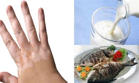 การกินนมและปลาร่วมกันทำให้เกิดโรคด่างขาวผู้เชี่ยวชาญพูดอย่างไรเกี่ยวกับ ...