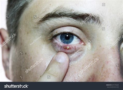 Photo De Stock Closeup Mans Eye Ophthalmologic Disease Hordeolum
