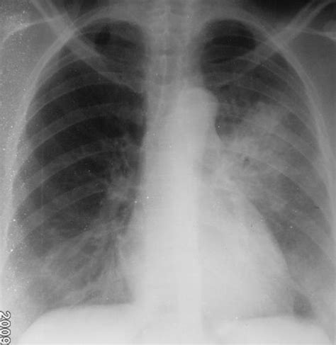 2 Chest Radiograph Showing Left Lower Lobe Pneumonia With Silhouette