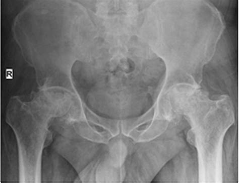 Bilateral Groin Pain In A Young Man The Bmj