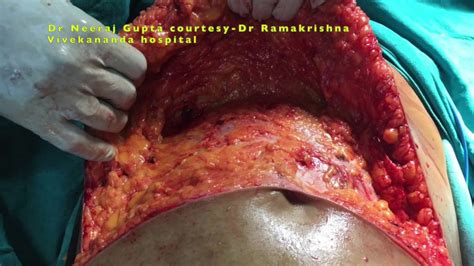What you can and should not do will be up to your own surgeon. Meshless Ventral hernia repair-broad hernia with divarication,Panniculectomy,abdominoplasty ...