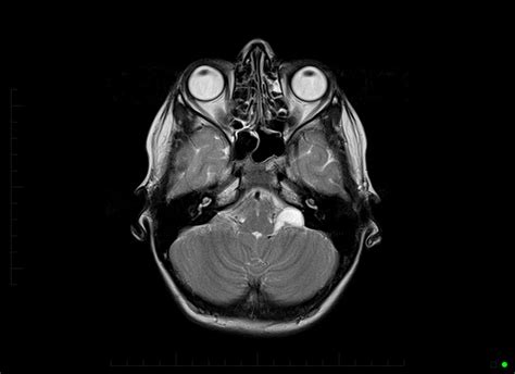Mri Brain Arachnoid Cyst 0001 Mri At Melbourne Radiology Clinic