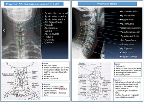 RadiografÍa Convencional Para El Estudio Del Dolor En El Cuello Dolopedia