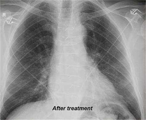 Congestive Heart Failure Chest X Ray