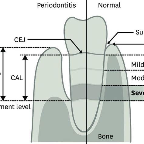 18,843 likes · 175 talking about this. Evaluation of the CAL in periodontitis. The CEJ is the ...