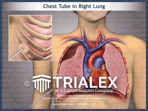 Chest Tube In Right Lung Trialexhibits Inc