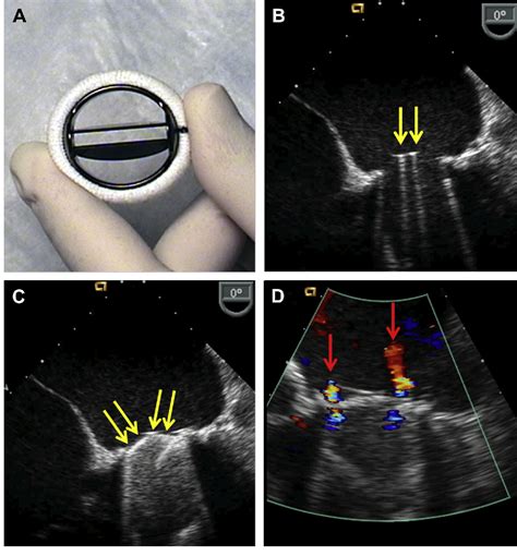 Figure 2 From Mitral Prosthetic Valve Assessment By Echocardiographic Guidelines Semantic Scholar