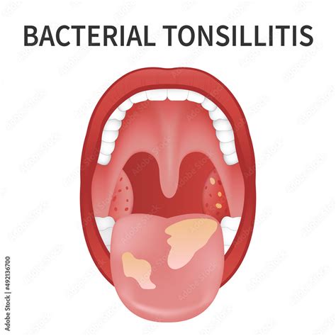 Bacterial And Viral Tonsillitis Angina Pharyngitis And Tonsillitis