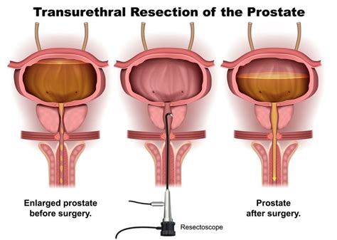 User S Guide To The Prostate Online Prescription Medications