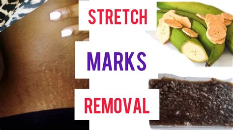 How To Remove Stretch Marks And Scars Fast Diy Remedy Youtube