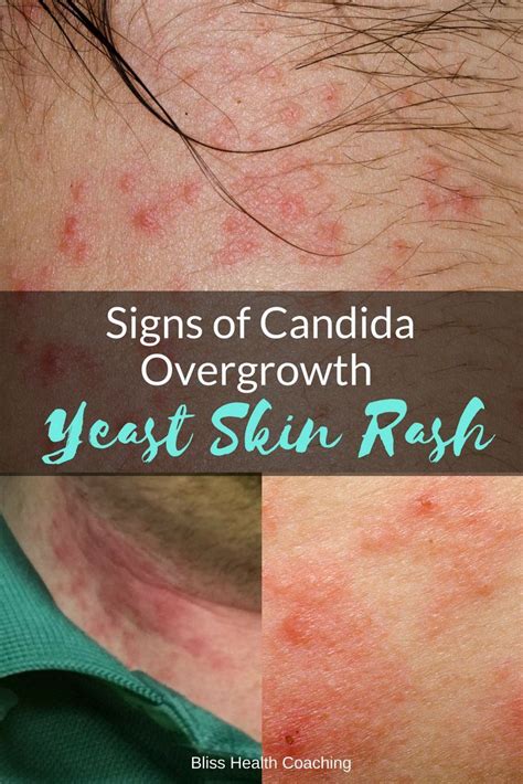 Are You Struggling With A Yeast Rash Candida Overgrowth Can Cause A