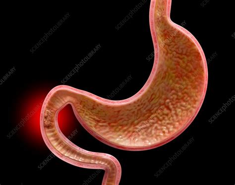 cancer of the small intestine illustration stock image c034 2676 science photo library