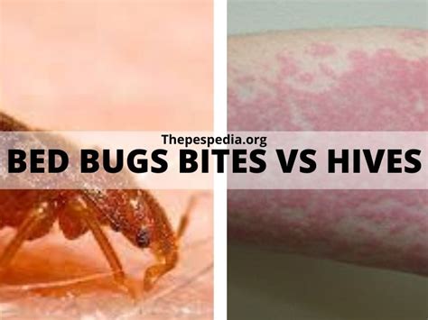 Bed Bugs Bites Vs Hives What Is The Difference {in Table}
