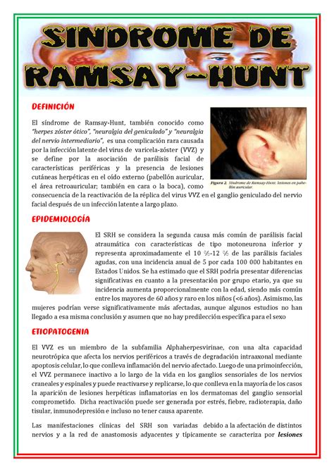 Síndrome De Ramsay Hunt Resúmenes De Medicina Interna Docsity