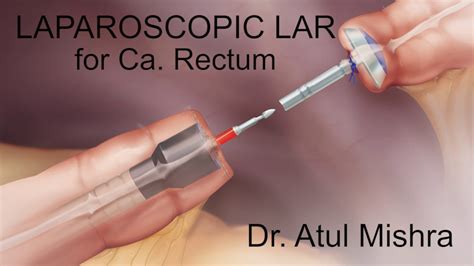 Laparoscopic Low Anterior Resection Tme For Rectum Cancer Atul