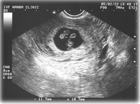 Need to pull off a fake pregnancy prank? Transvaginal ultrasound at 7+3/7 weeks of gestation. Two ...