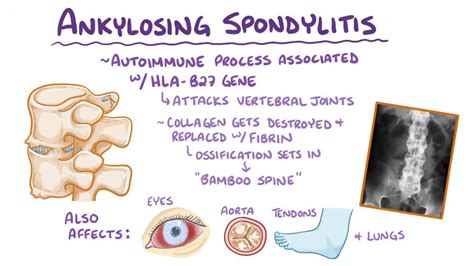 Ankylosing Spondylitis Osmosis