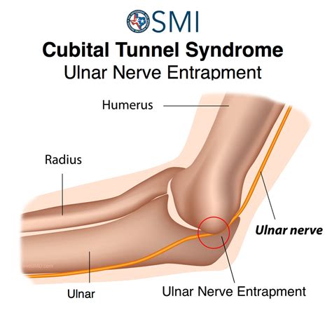 Cubital Tunnel Syndrome The Orthopedic And Sports Medicine Institute In