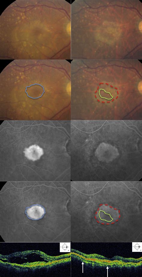 Intralesional Macular Atrophy In Antivascular Endothelial Growth