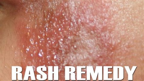 How To Get Rid Of Rashes │ Home Remedies For Rashes │ Health Care