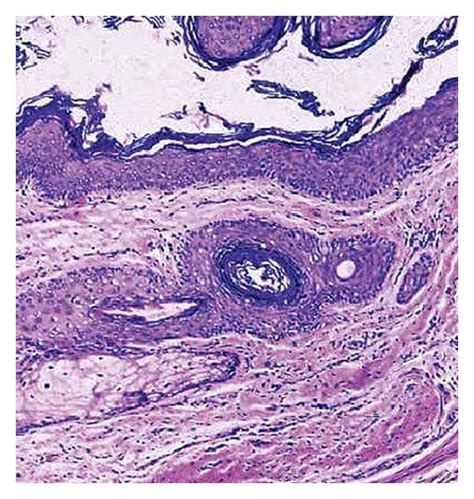 Keratinizing Squamous Epithelium With Distinct Granular Layer With A