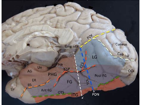 Inferomedial View Of The Basal Occipitaltemporal Lobe A Coronal Line