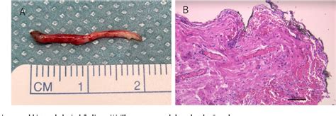 Figure From Ureteral Fibroepithelial Polyp A Case Report Semantic