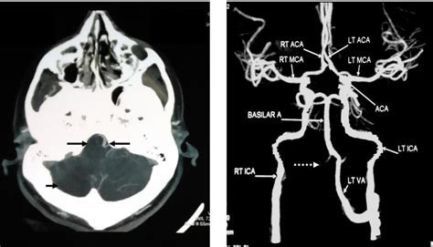 Ct Scan Brain And Cta Cervical Arteries Download Scientific Diagram