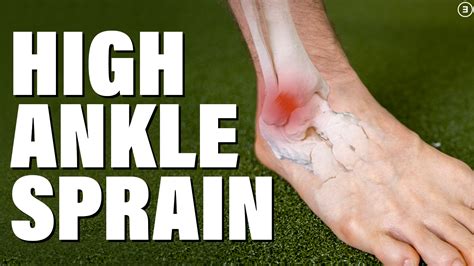 High Ankle Sprain E3 Rehab