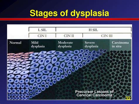 Cervical Dysplasia Stages