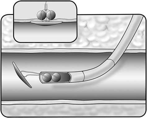 A Systematic Review Of Vascular Closure Devices For Femoral Artery