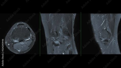 Vidéo Stock Compare Of Mri Knee Or Magnetic Resonance Imaging Of Knee