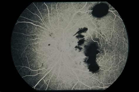 Trauma With Hemorrhages Optic Nerve Swelling Retina Image Bank