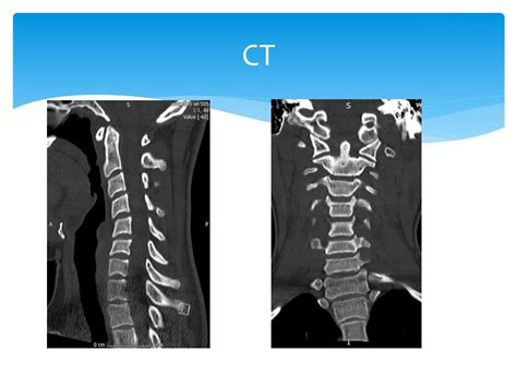 Ppt The Cervical Spine Normal Anatomy Variants And Pathology