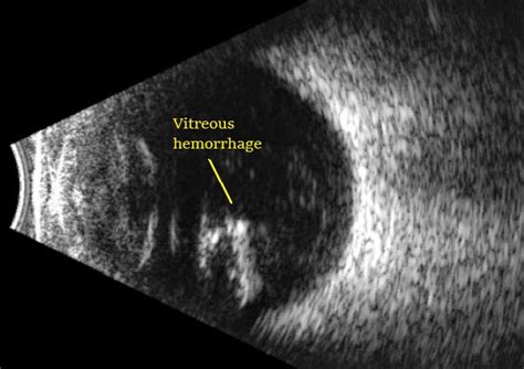 Bright Scan Ultrasound B Scan